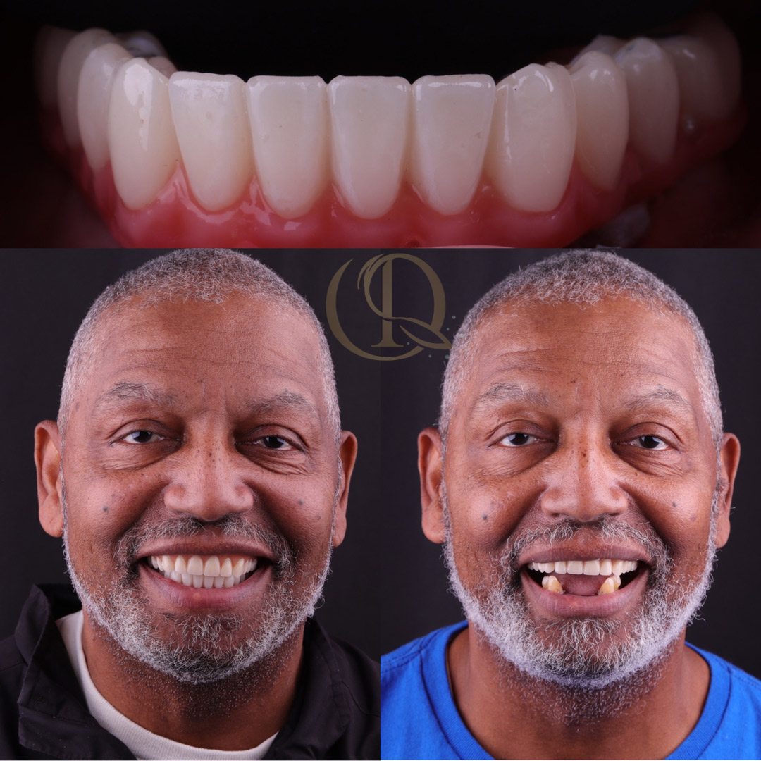 Overdenture dental implant
