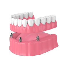 illustration of All-On-X Implant-Supported Dentures