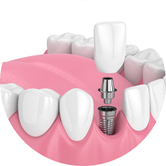 illustration of a dental implant