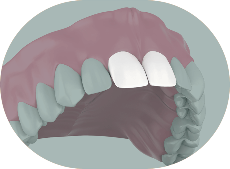illustration of partial dentures