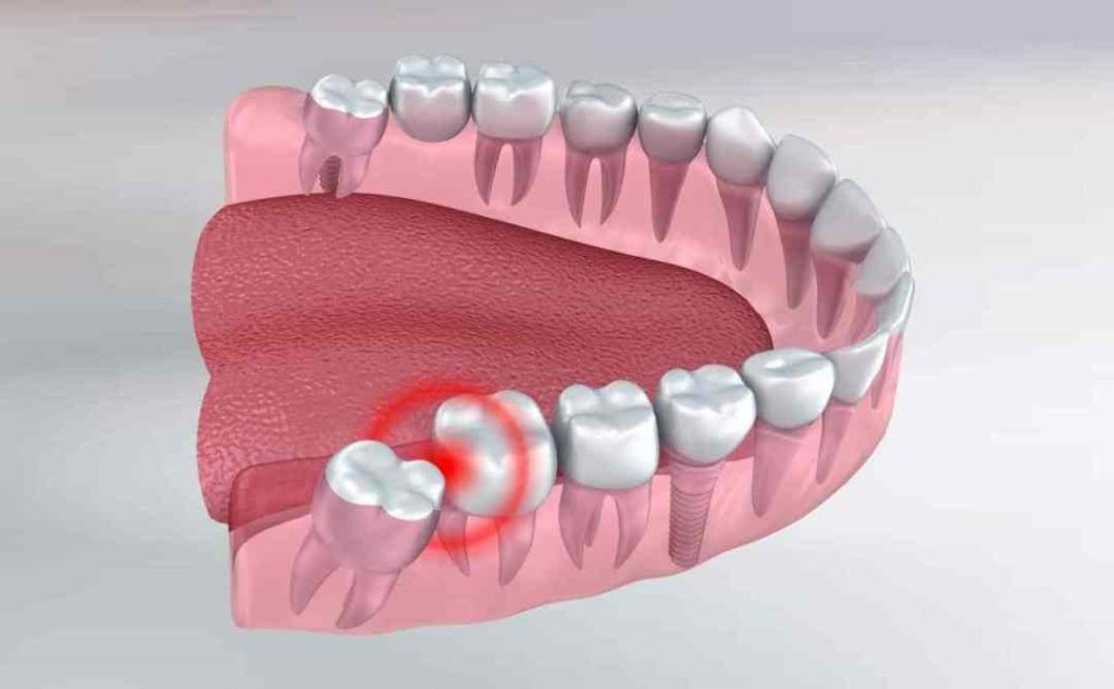 Effective Natural Cures To Soothe Wisdom Toothache Odyssey Dental Of Summerfield