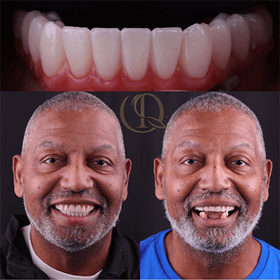 Lower Implant Denture