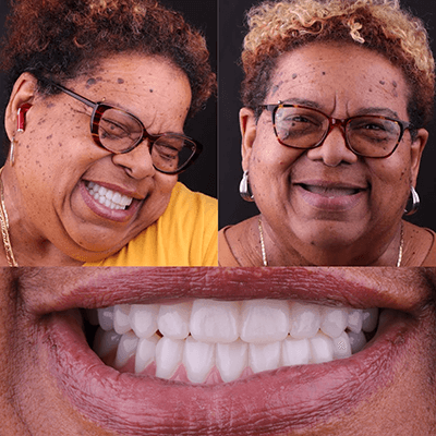 Upper Implant Denture