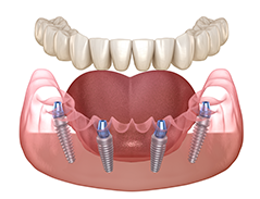 dental implant