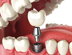 dental implant