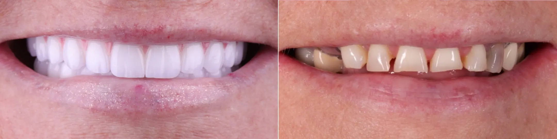 all on 4 dental implants before and after