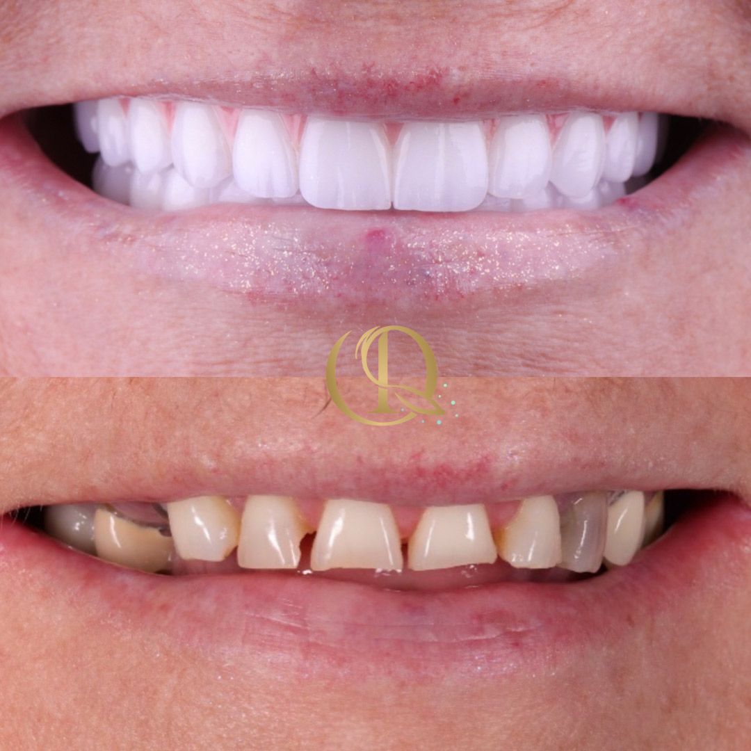 Upper Lower dental implant