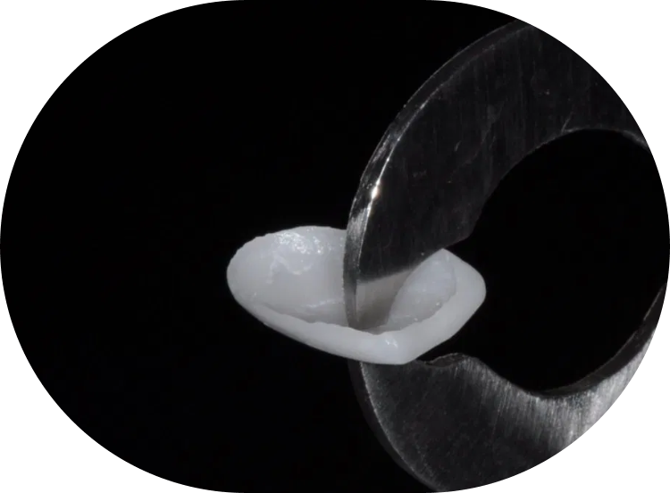 close up of a single porcelain dental veneer