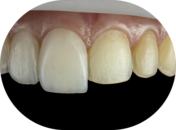 close up of dental veneers placed over half of the top arch of front teeth
