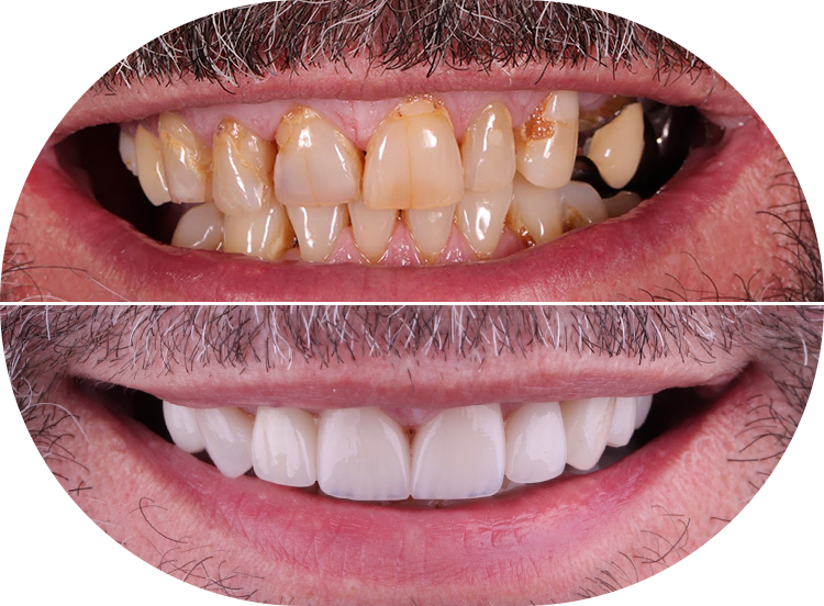 restorative dental work patient before on the top and after on the bottom
