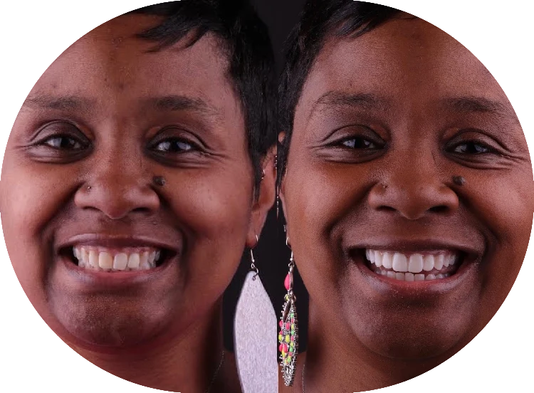 smile makeover patient before and after