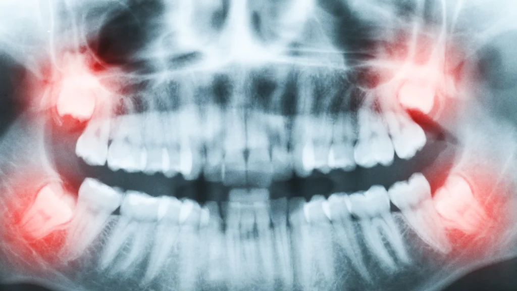 wisdom teeth shown on a dental x-ray