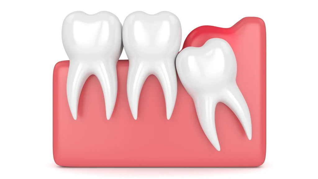 illustration depicting a wisdom tooth about to erput through the gum line